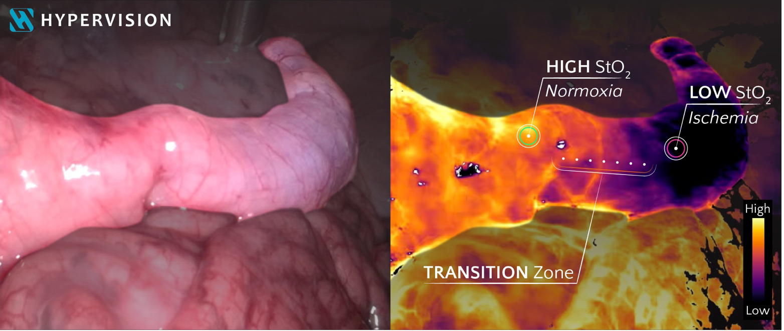 Hypervision RGB and superficial tissue oxygenation